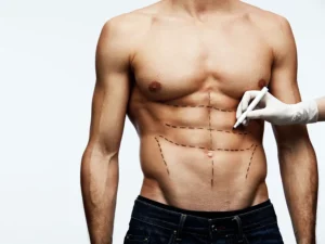 Abdominoplastie à Vannes en Morbihan.