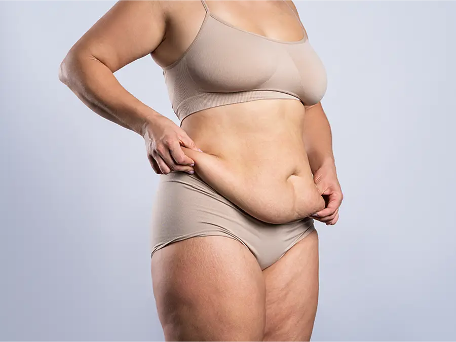Abdominoplastie en Morbihan.