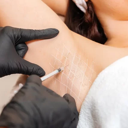 Injections botox pour hypersudation