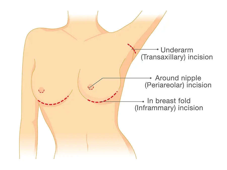 schema augmentation mammaire